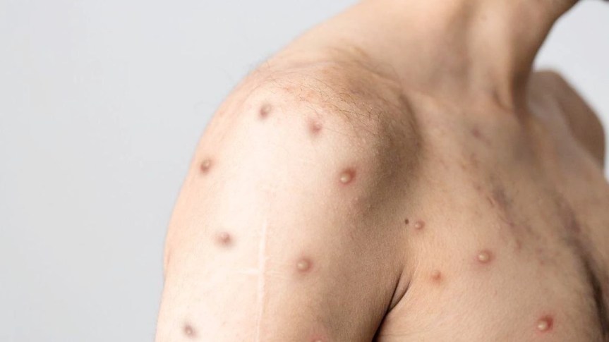 Ministério da Saúde alerta para surto do vírus da varíola e recomenda vigilância nos estados e&nbsp;municípios